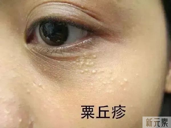 如何区分脂肪粒与粉刺?看这4点就够了 图片-7