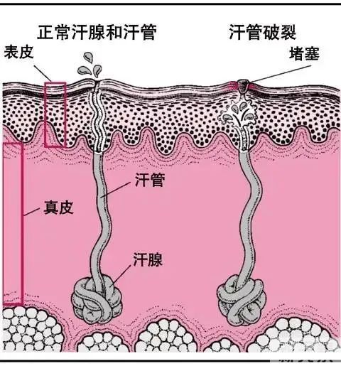 如何区分脂肪粒与粉刺?看这4点就够了 图片-8