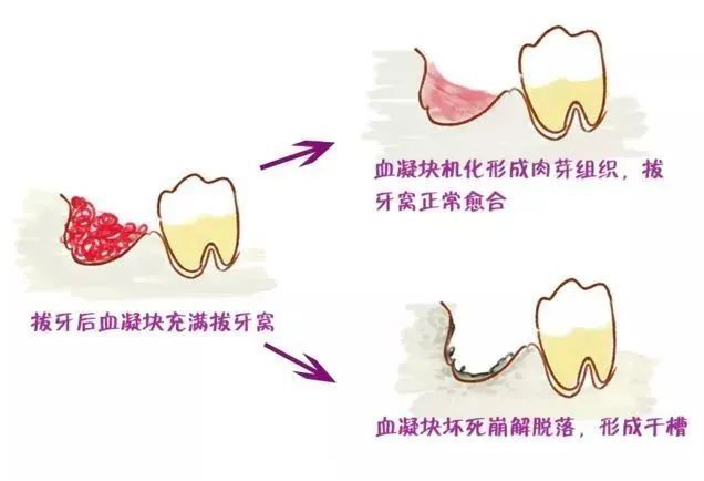 拔完牙后，该怎么刷牙呢?牙窟窿又是如何愈合的? 图片-4