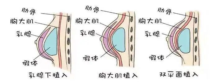 为什么说「取出乳房假体」的同时进行「脂肪移植」是最佳时期? 图片-5