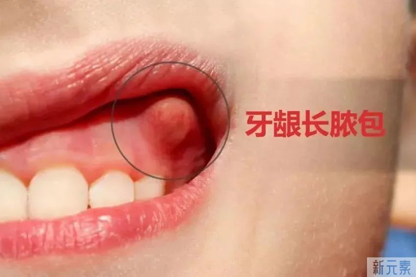 牙齿反复痛后又不痛了，是自愈了吗?还要不要看牙医? 图片-11