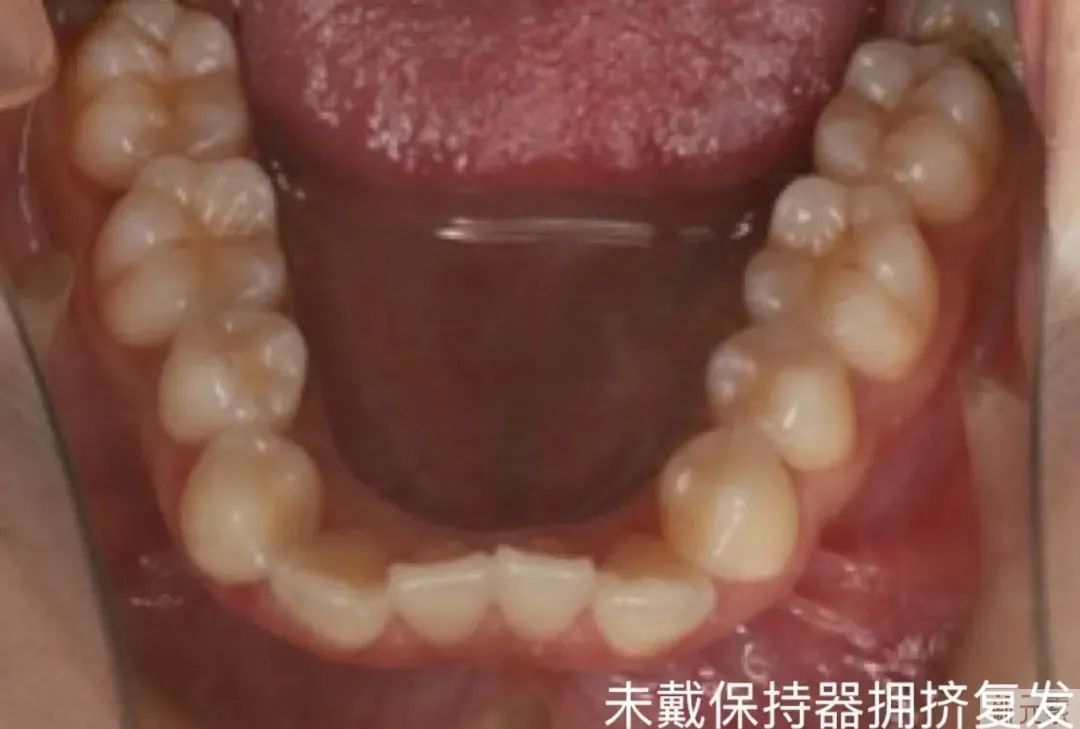 正畸后佩戴保持器究竟有多重要? 图片-14