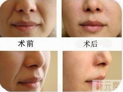 鼻唇沟分类型对症治疗 图片-7