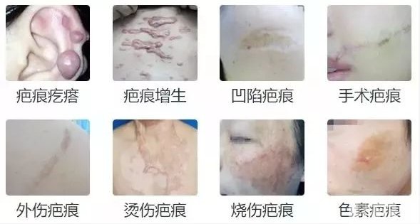新疤痕与旧疤痕，修复方式有哪些不同? 图片-1