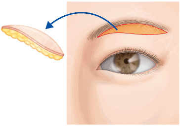一术三效的提眉术(改善眼角皱纹、增大眼睛、修缮眉形) 图片-1