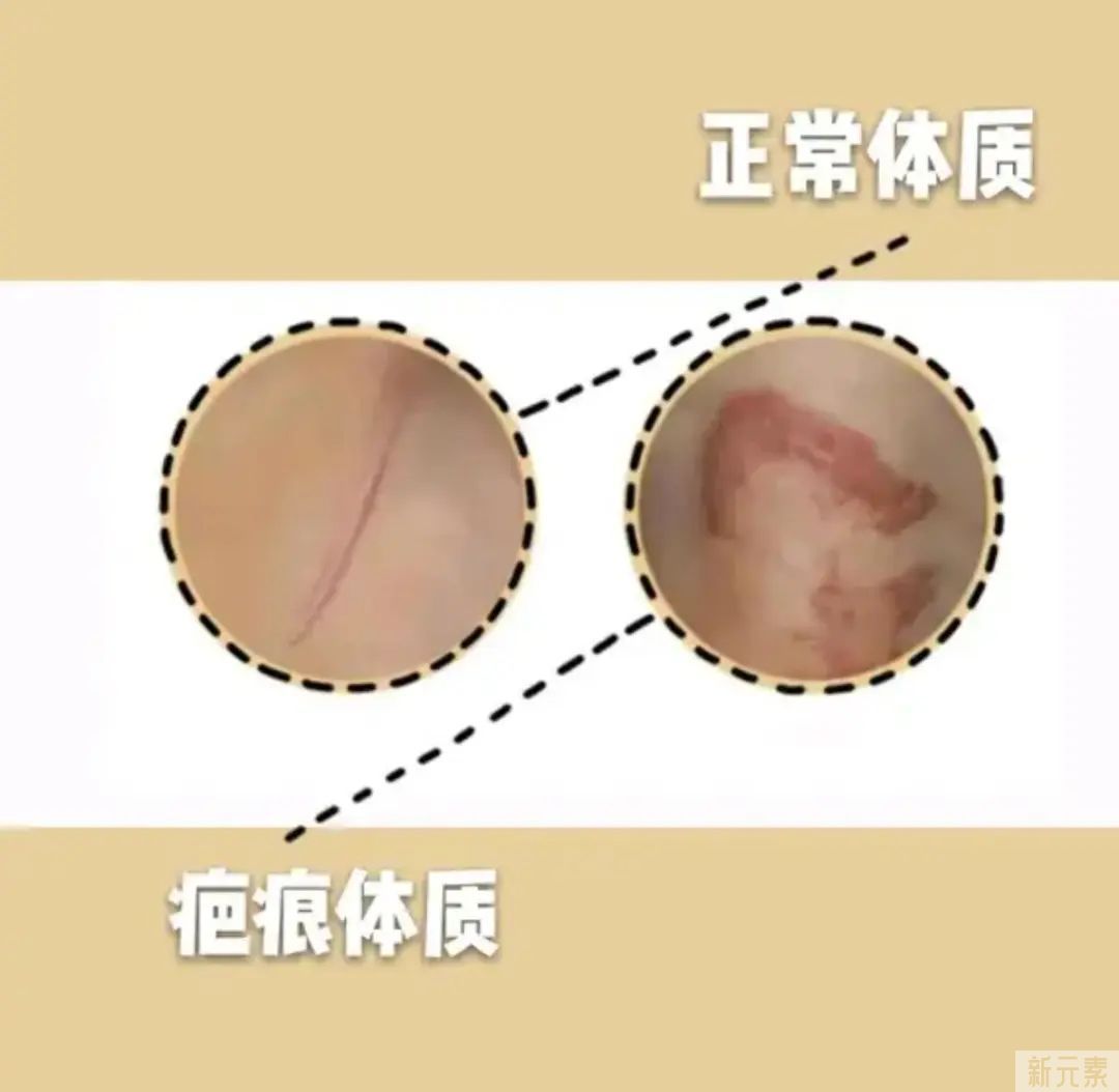 伤口缝合后疤痕为什么会长成蜈蚣状? 图片-12