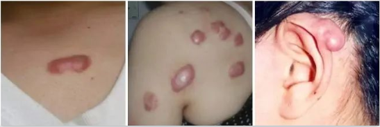 什么是疤痕体质?怎样才能预防疤痕? 图片-3