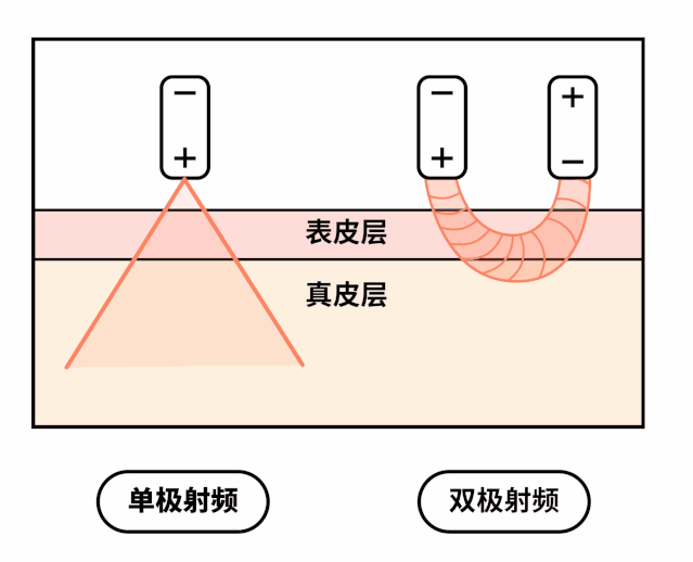 热玛吉治疗全过程，做完你就知道这个银子没白花! 图片-9