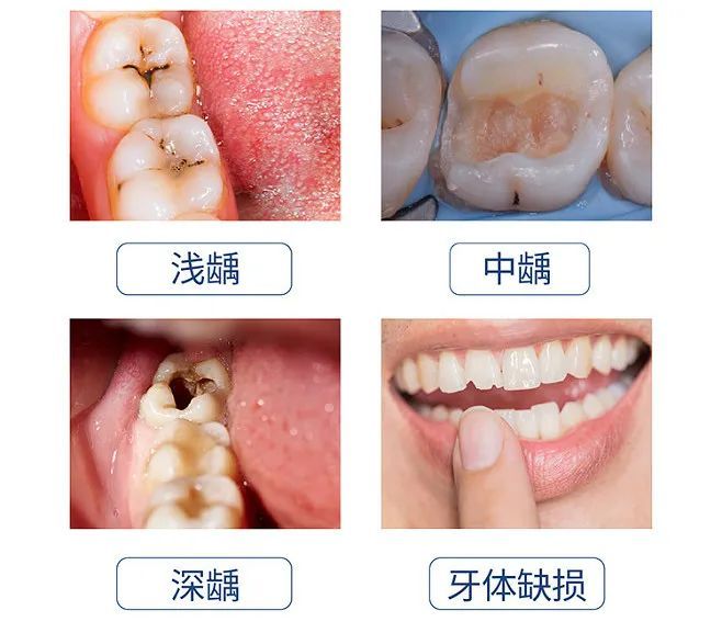 90%的牙痛，都是这些原因造成的! 图片-5
