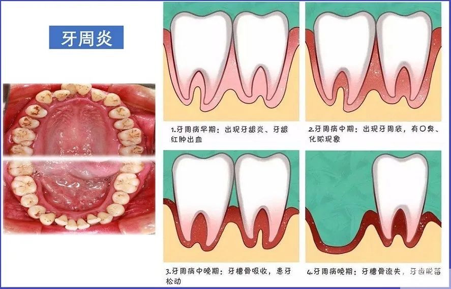 90%的牙痛，都是这些原因造成的! 图片-15