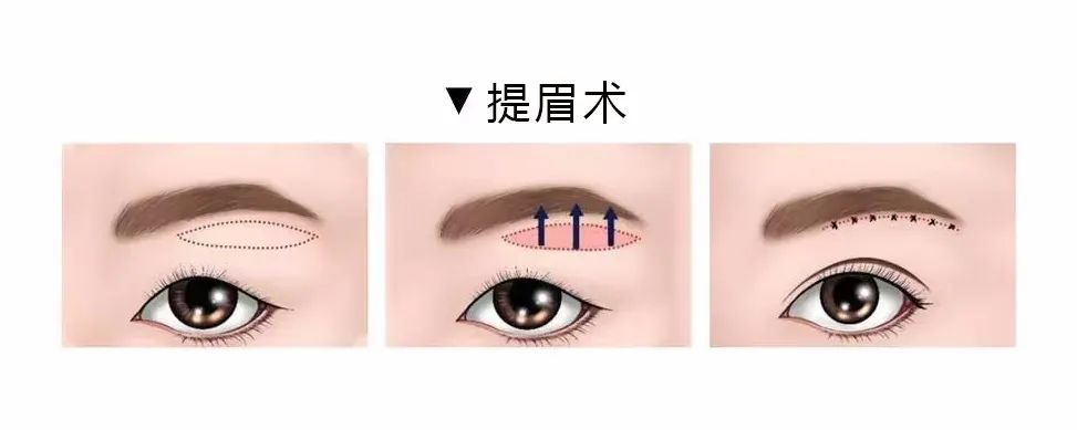 整形无小事丨上眼皮松弛，手术要这么选! 图片-11