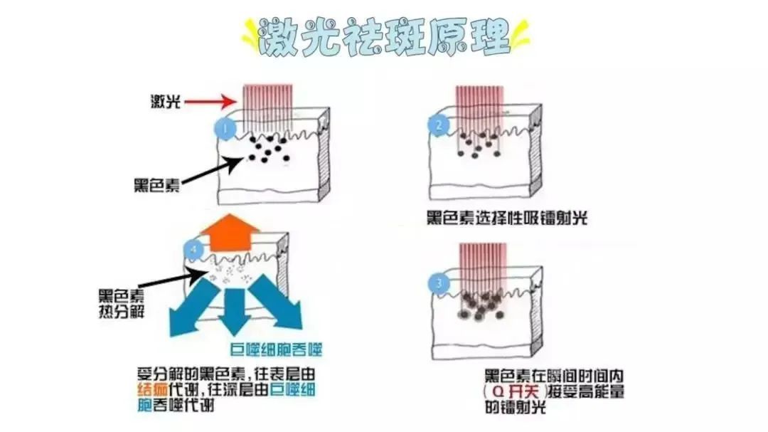 科普篇丨光子、射频、激光哪个更适合你? 图片-7