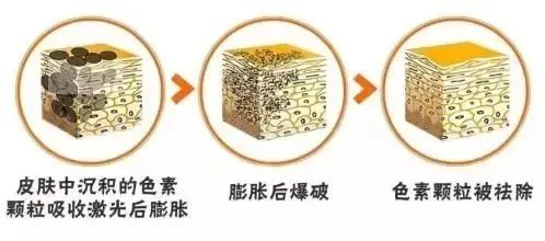 科普篇丨光子、射频、激光哪个更适合你? 图片-8