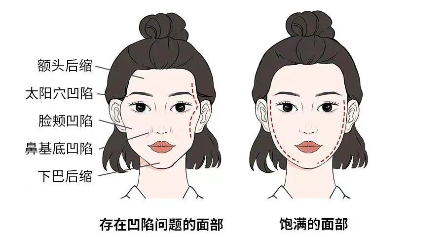 不同类型的玻尿酸怎么选?搞懂这些，面部填充省钱又省力! 图片-11
