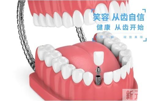 速答:做完种植牙后，还能吸烟吗? 图片-5