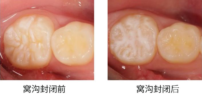 【护牙攻略】如何让您的孩子拥有一口好牙? 图片-8