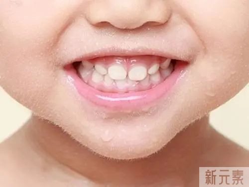 科普:一笑就会露牙龈，需要矫正吗? 图片-8