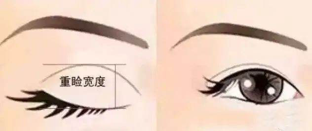 一个自然的双眼皮是多宽?3分钟看懂，不走弯路! 图片-3