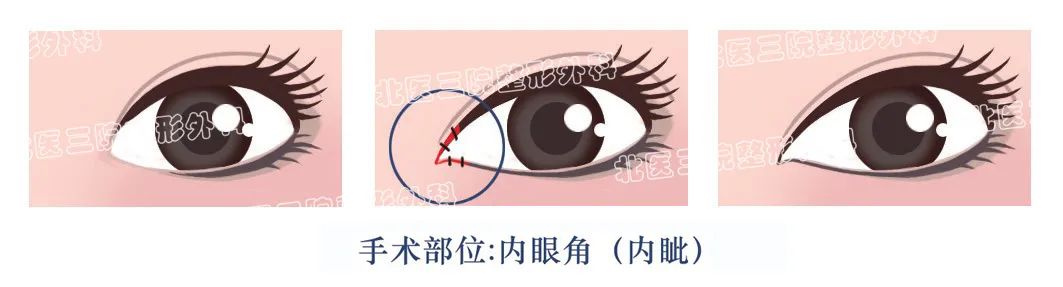 开眼角，怎么开? 图片-1