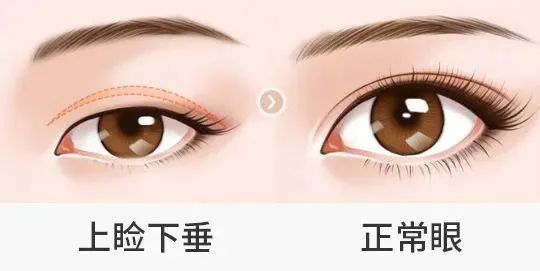 整形无小事丨眼综合，到底包括什么? 图片-5