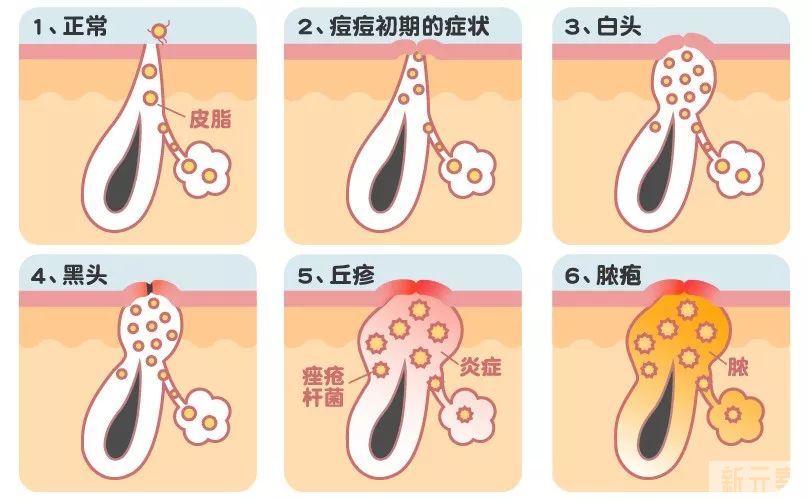 老痘没走，新痘又来?祛痘反复怎么办? 图片-3