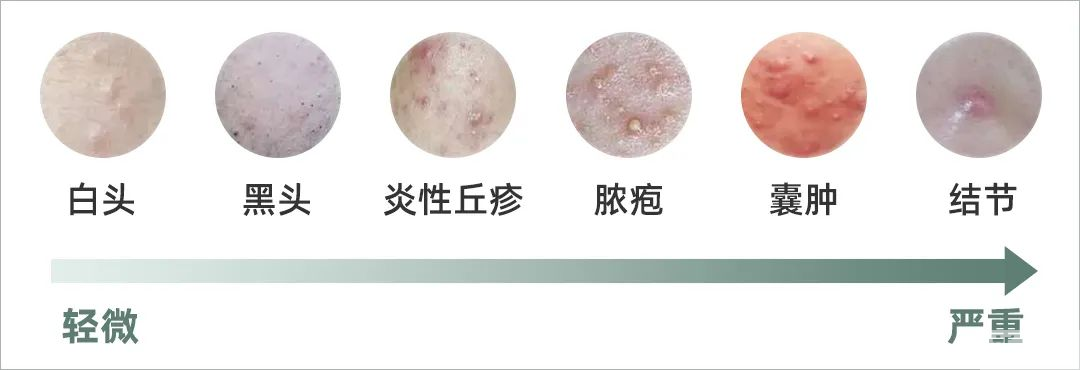 老痘没走，新痘又来?祛痘反复怎么办? 图片-4