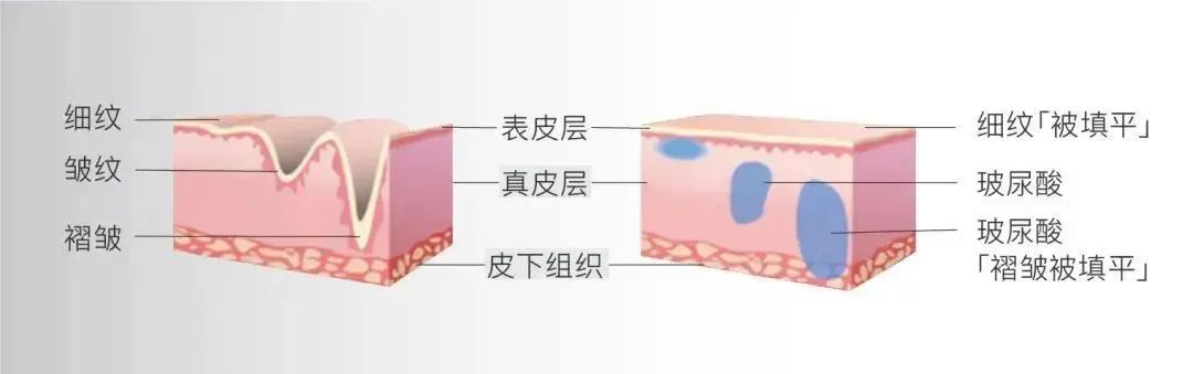 肉肉脸VS干瘪脸，抗衰方法你选对了吗? 图片-7