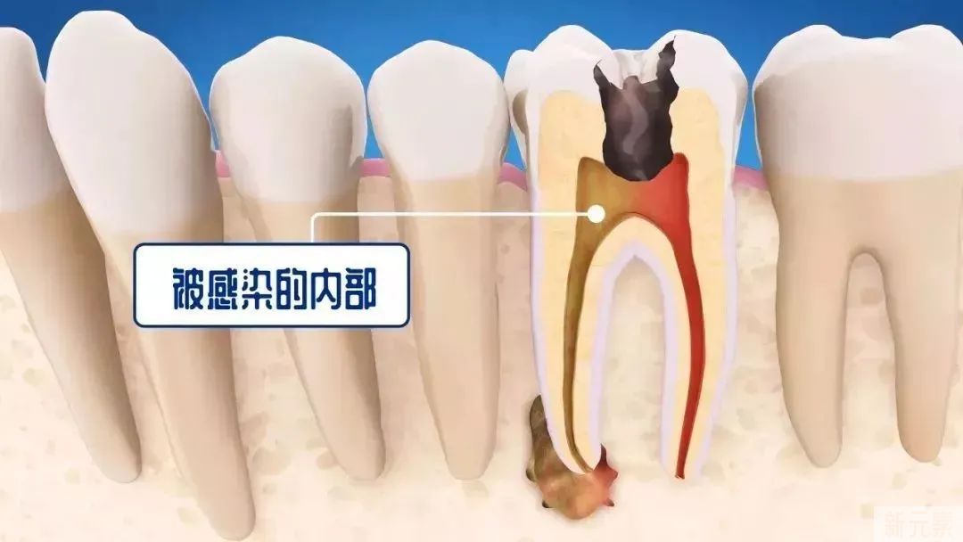 【名医说】为什么医生建议我先根管治疗而不是补牙? 图片-7