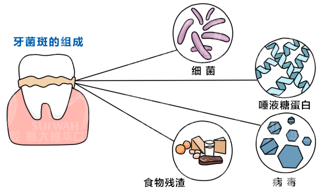 千万别小看牙结石，当心它“掏空”你的牙齿! 图片-3