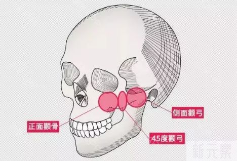 科普 | 颧骨突出该如何改善? 图片-4