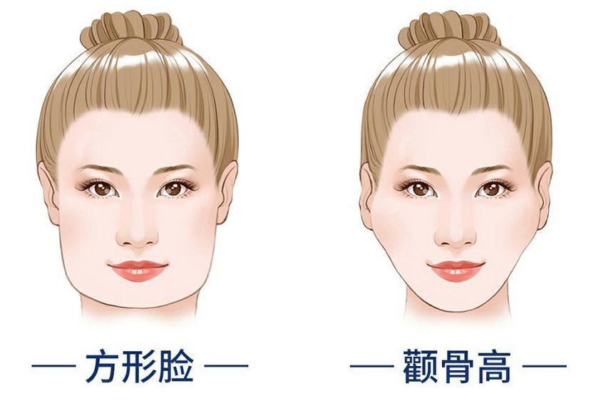 科普 | 颧骨突出该如何改善? 图片-5