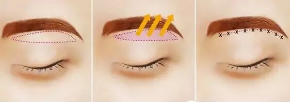 眼皮松松垮垮的，该做提眉还是割双眼皮? 图片-2