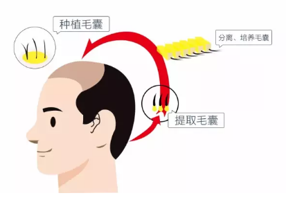 哪些因素会影响植发后的毛囊成活率? 图片-2