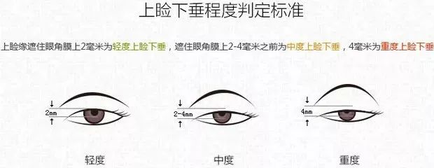 坦白局:不是每个双眼皮都需要做提肌! 图片-7
