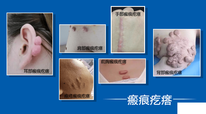 疤痕疙瘩反复溃烂怎么办?别慌，医生教你这样做! 图片-5