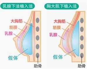 隆胸后，假体到底会不会被对象摸出来? 图片-8