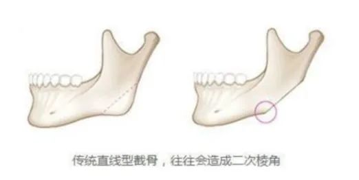 磨骨后一眼就能被识破?5个关于磨骨的误区，骗了多少人 图片-4