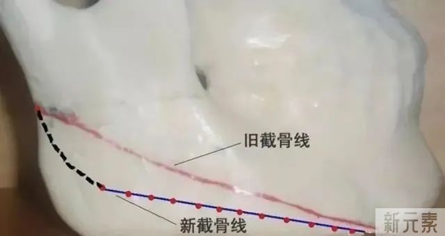 磨骨后一眼就能被识破?5个关于磨骨的误区，骗了多少人 图片-5