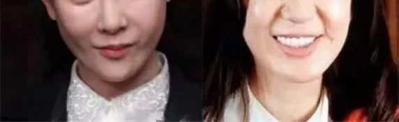 同样是填充，为啥你是“馒头脸”，别人却自然减龄?避坑这3点 图片-5