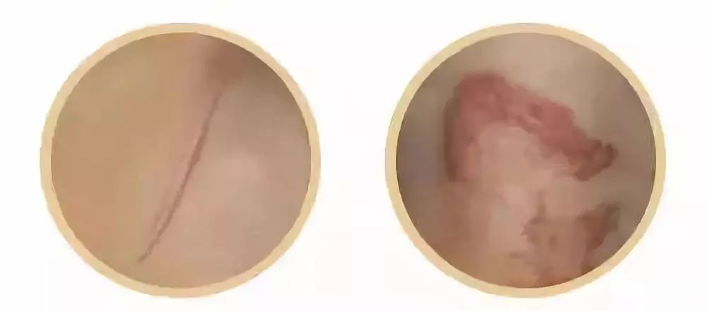 身上的伤疤难消退，就是疤痕体质吗? 图片-8