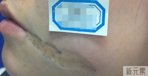 不同类型凹陷疤的修复方法，你一定要知道! 图片-4