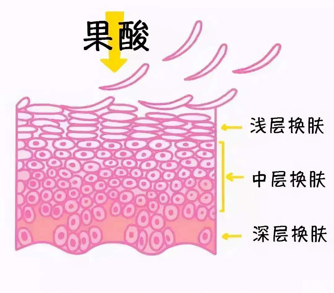 变美秘籍 | 医美方法收缩毛孔有哪些项目? 图片-6