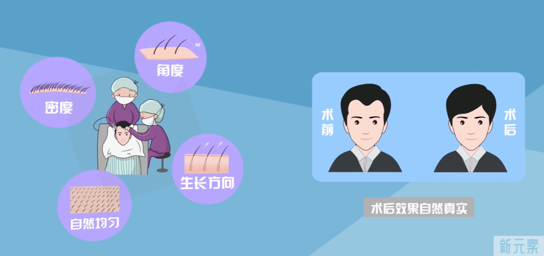 植发知多少之~手术流程知多少 图片-5
