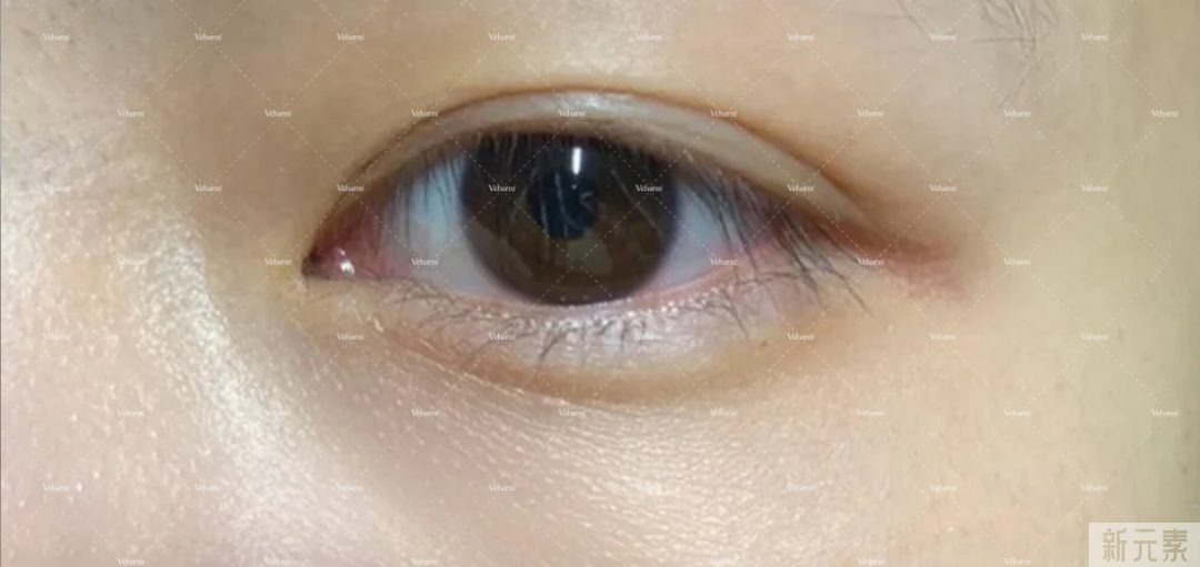 痔疮膏祛眼袋是什么鬼?祛眼袋的3个雷区和4个正确方法，现在讲清楚! 图片-14