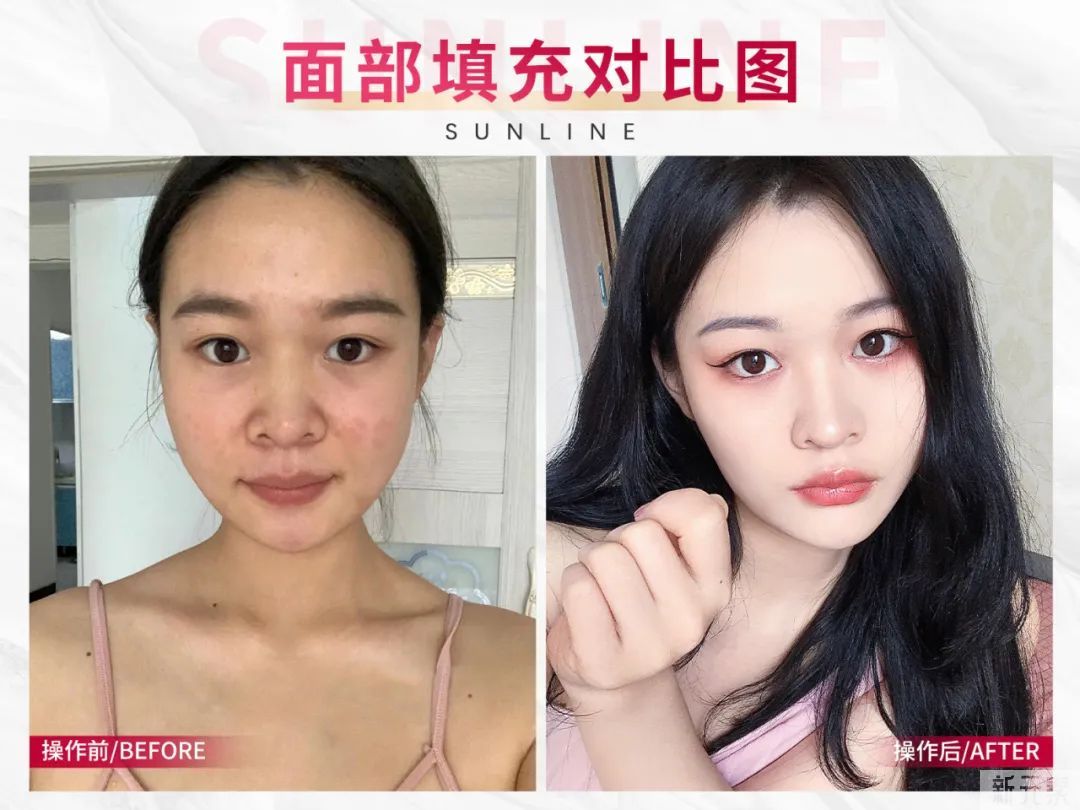 想做医美?中韩医美功课看这里! 图片-5