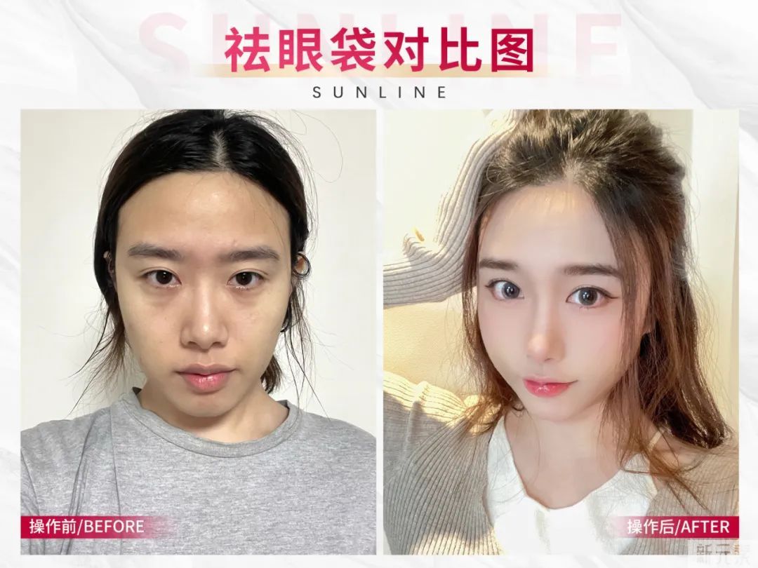 想做医美?中韩医美功课看这里! 图片-6
