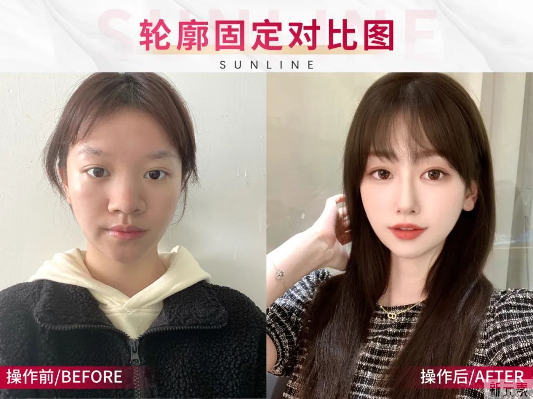 想做医美?中韩医美功课看这里! 图片-7