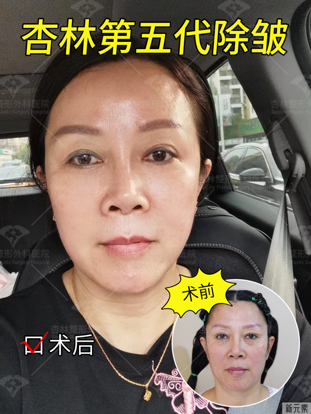 皮肤“松”和“垂”不是一回事!抗衰无效，是你思路不对! 图片-11