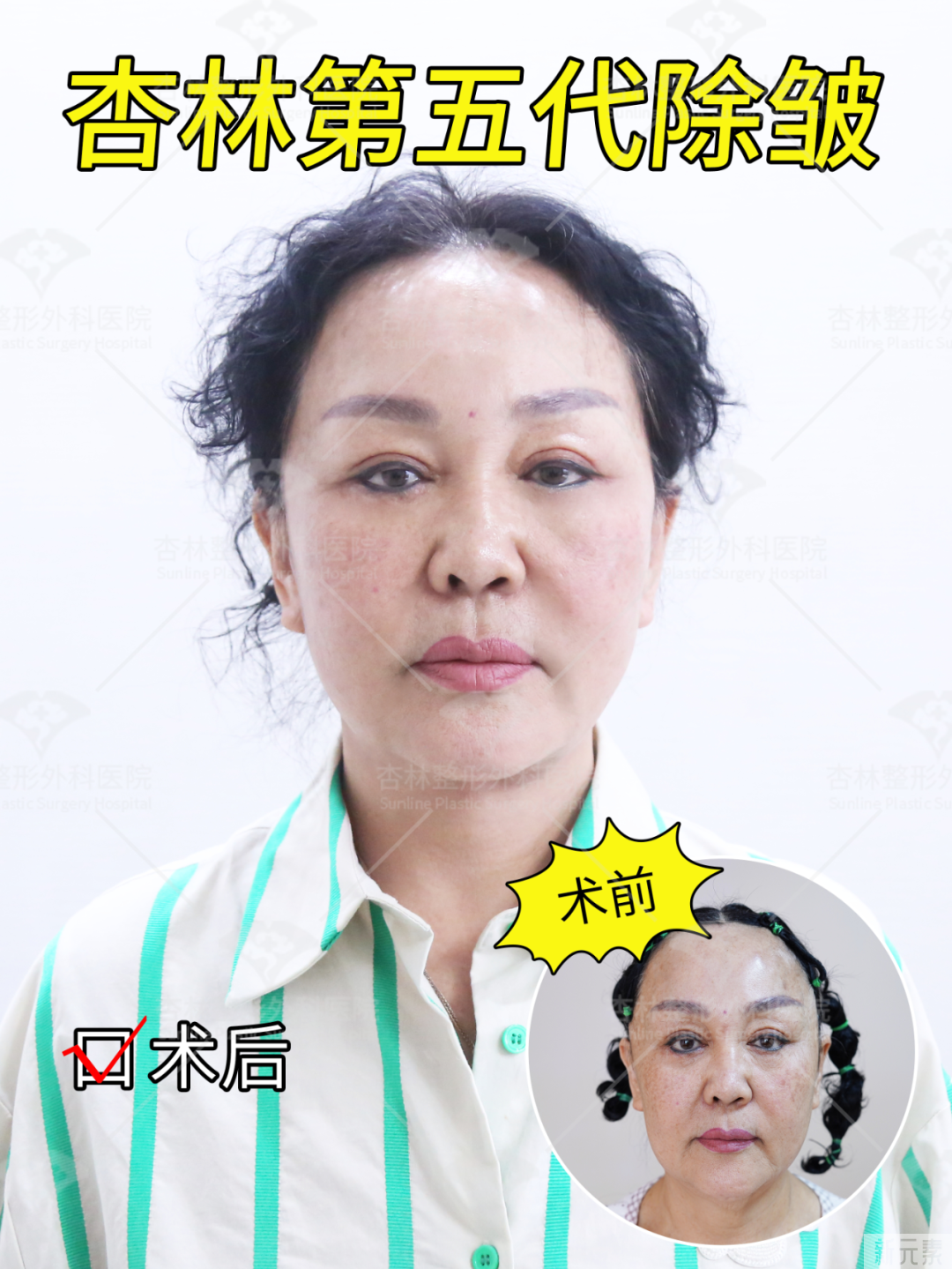 皮肤“松”和“垂”不是一回事!抗衰无效，是你思路不对! 图片-19