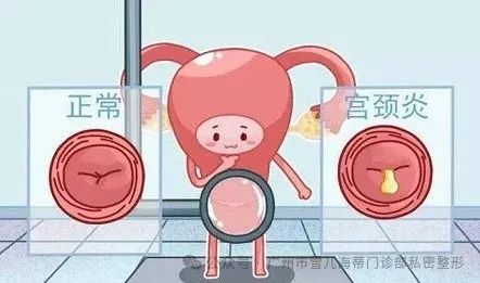 产后阴道松弛具体是什么样的感觉? 图片-2